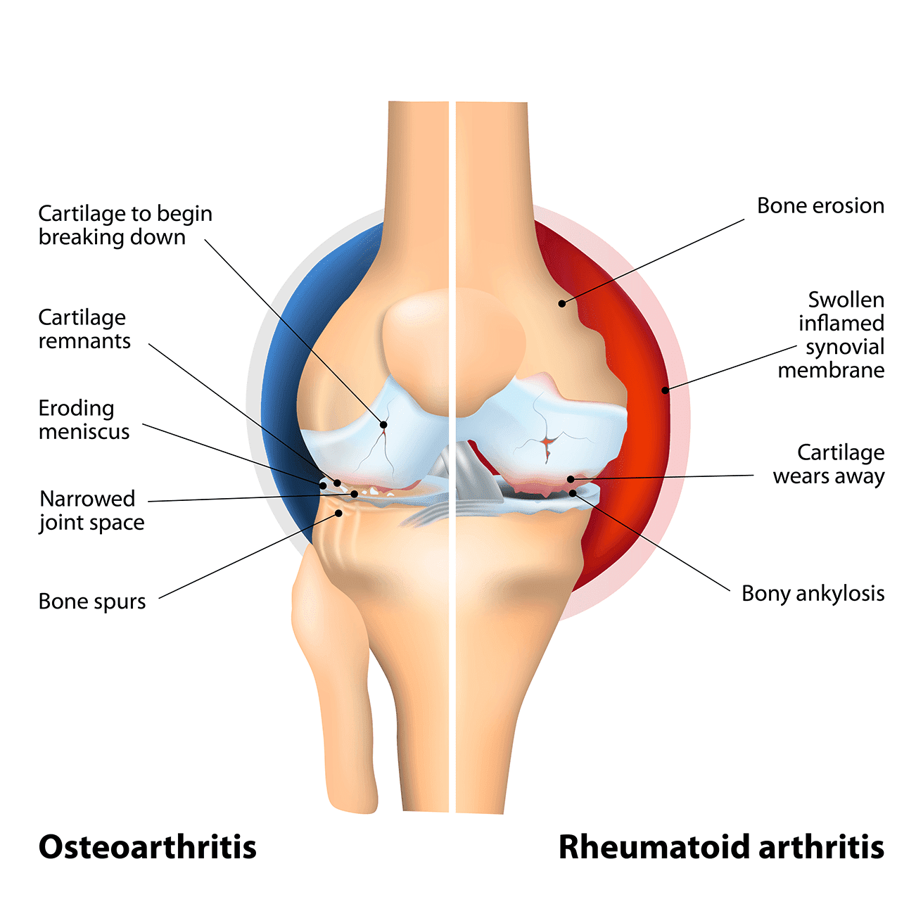 comparison of osteoarthritis and rheumatoid arthritis