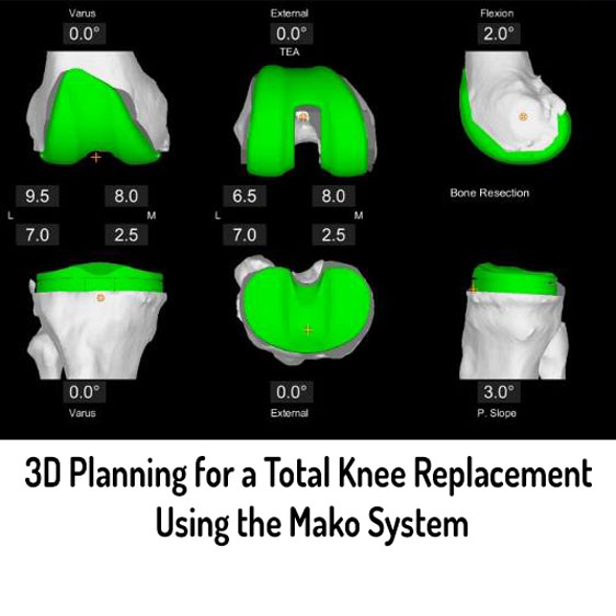 Total Knee Replacement 3D Planning