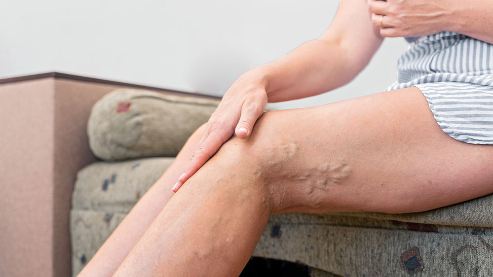 woman with varicose veins