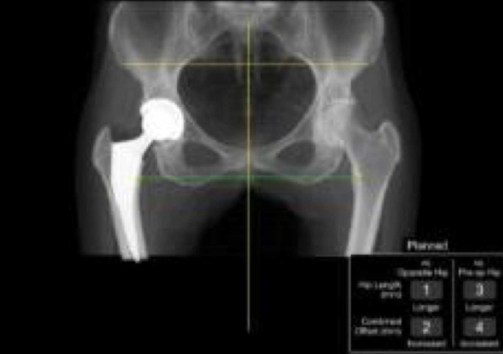 Hip with transplant